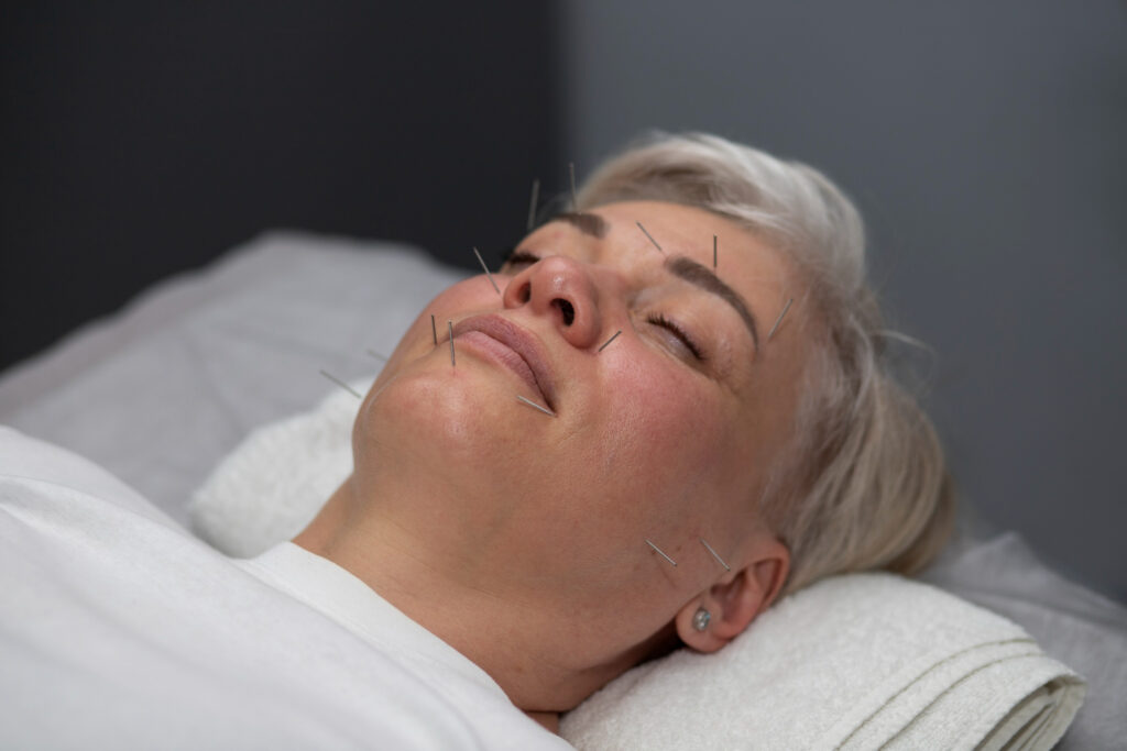 A acupuntura pode ajudar a controlar os sintomas da menopausa, especialmente aqueles ligados à saúde mental. 