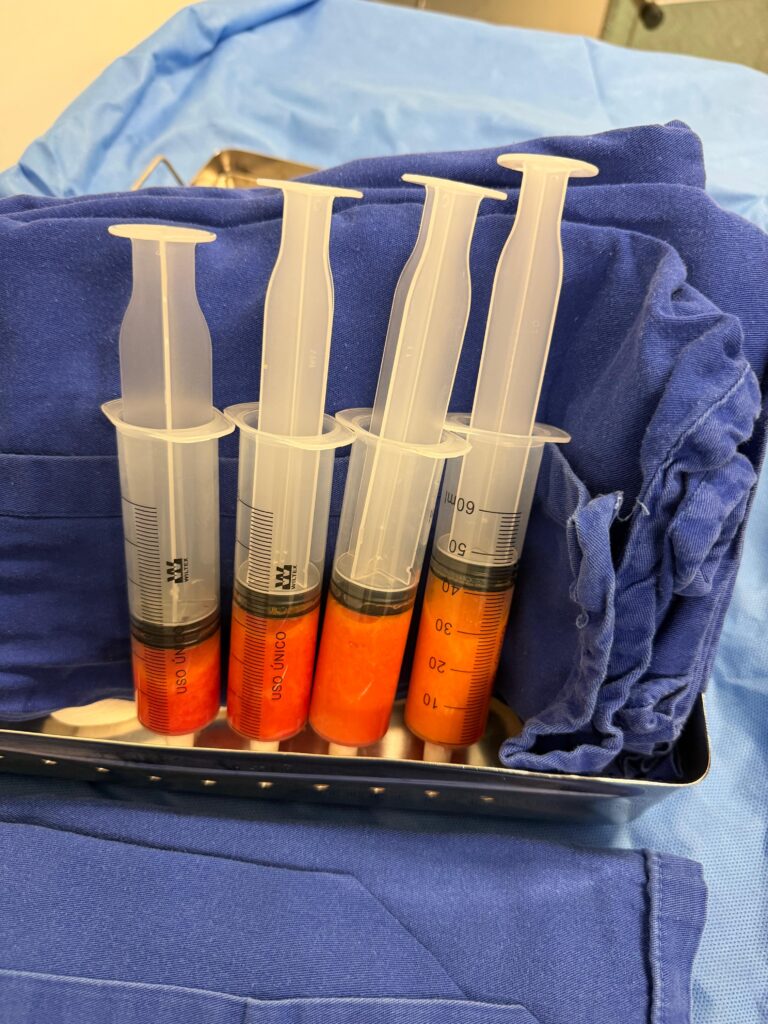 A Lipoenxertia - que utiliza a gordura da própria paciente - está ajudando na reconstrução mamária pós-câncer. A técnica está sendo oferecida pelo SUS, em Londrina