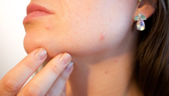 acne-1606765_1920