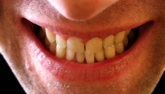 dentes