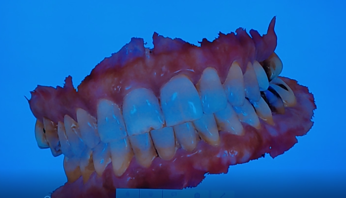 dentis