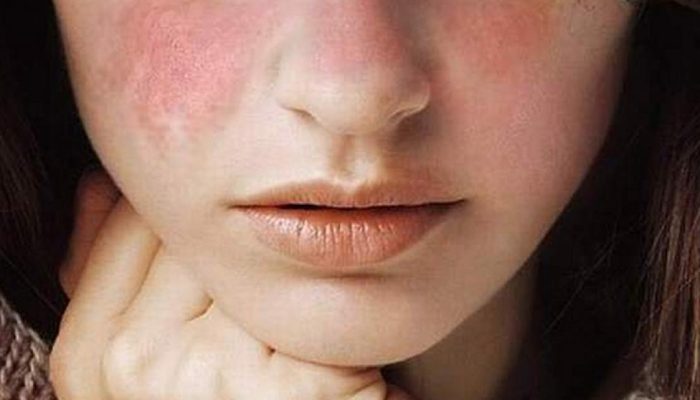 lupus