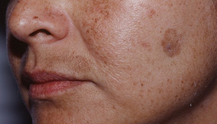 melasma