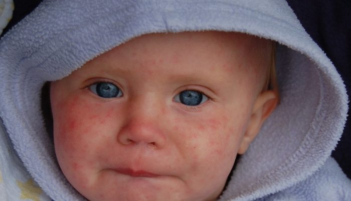 Measles